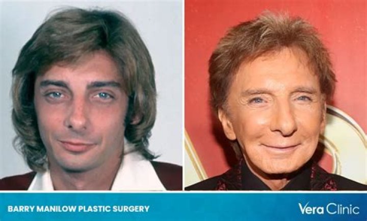 Barry Manilow Plastic Surgery, Has Barry Manilow Had Cosmetic Surgery?