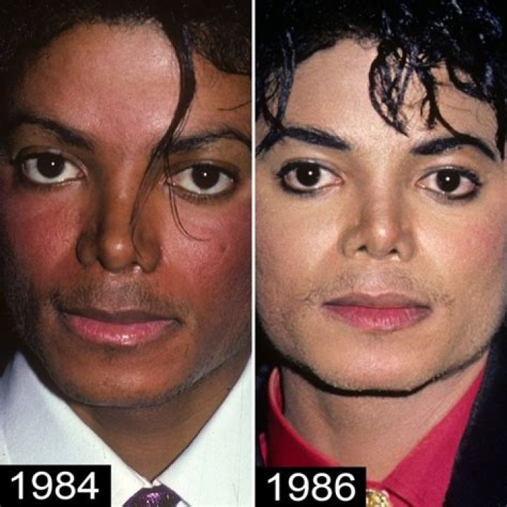 Michael Jackson Before and After Plastic Surgery and Transformation ·